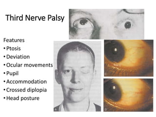 Third Nerve Palsy
Features
•Ptosis
•Deviation
•Ocular movements
•Pupil
•Accommodation
•Crossed diplopia
•Head posture
 