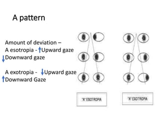 A pattern
Amount of deviation –
A esotropia - Upward gaze
Downward gaze
A exotropia - Upward gaze
Downward Gaze
 