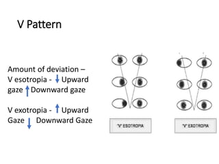 V Pattern
Amount of deviation –
V esotropia - Upward
gaze Downward gaze
V exotropia - Upward
Gaze Downward Gaze
 