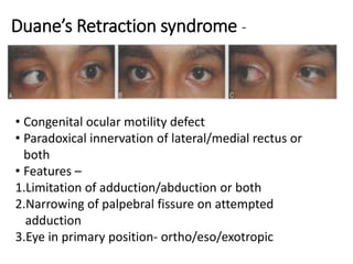 Duane’s Retraction syndrome -
• Congenital ocular motility defect
• Paradoxical innervation of lateral/medial rectus or
both
• Features –
1.Limitation of adduction/abduction or both
2.Narrowing of palpebral fissure on attempted
adduction
3.Eye in primary position- ortho/eso/exotropic
 