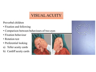 VISUAL ACUITY
Preverbal children
• Fixation and following
• Comparison between behaviours of two eyes
• Fixation behaviour
• Rotation test
• Preferential looking
a) Teller acuity cards
b) Cardiff acuity cards
 