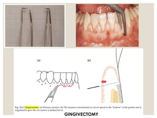 Instruments , incisons and basics of flap design for periodontal ...
