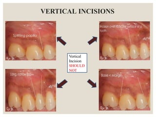 Instruments , incisons and basics of flap design for periodontal ...