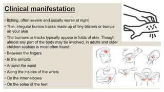 Clinical manifestation
• Itching, often severe and usually worse at night
• Thin, irregular burrow tracks made up of tiny blisters or bumps
on your skin
◦ The burrows or tracks typically appear in folds of skin. Though
almost any part of the body may be involved, in adults and older
children scabies is most often found:
• Between the fingers
• In the armpits
• Around the waist
• Along the insides of the wrists
• On the inner elbows
• On the soles of the feet
 