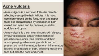 Acne vulgaris
◦ Acne vulgaris is a common follicular disorder
affecting susceptible hair follicles. It is most
commonly found on the face, neck and upper
trunk It is characterized by comedones both
closed and open and by papules, pustules,
nodules and cysts.
◦ Acne vulgaris is a common chronic skin disease
involving blockage and/or inflammation of
pilosebaceous units (hair follicles and their
accompanying sebaceous gland). Acne can
present as noninflammatory lesions, inflammatory
lesions, or a mixture of both, affecting mostly the
face but also the back and chest.
 