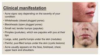 Clinical manifestation
◦ Acne signs vary depending on the severity of your
condition:
• Whiteheads (closed plugged pores)
• Blackheads (open plugged pores)
• Small red, tender bumps (papules)
• Pimples (pustules), which are papules with pus at their
tips
• Large, solid, painful lumps under the skin (nodules)
• Painful, pus-filled lumps under the skin (cystic lesions)
◦ Acne usually appears on the face, forehead, chest,
upper back and shoulders.
 