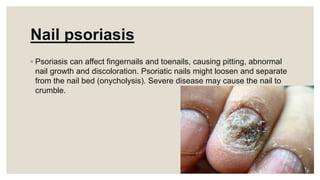 Nail psoriasis
◦ Psoriasis can affect fingernails and toenails, causing pitting, abnormal
nail growth and discoloration. Psoriatic nails might loosen and separate
from the nail bed (onycholysis). Severe disease may cause the nail to
crumble.
 