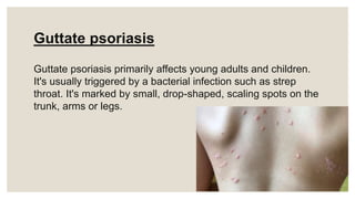 Guttate psoriasis
Guttate psoriasis primarily affects young adults and children.
It's usually triggered by a bacterial infection such as strep
throat. It's marked by small, drop-shaped, scaling spots on the
trunk, arms or legs.
 