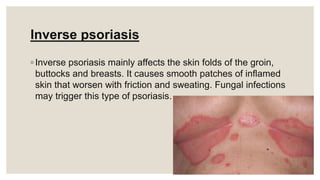 Inverse psoriasis
◦ Inverse psoriasis mainly affects the skin folds of the groin,
buttocks and breasts. It causes smooth patches of inflamed
skin that worsen with friction and sweating. Fungal infections
may trigger this type of psoriasis.
 