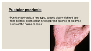 Pustular psoriasis
◦ Pustular psoriasis, a rare type, causes clearly defined pus-
filled blisters. It can occur in widespread patches or on small
areas of the palms or soles.
 