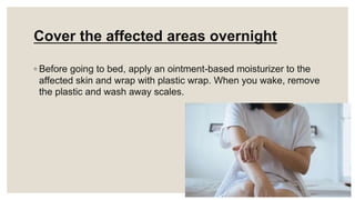 Cover the affected areas overnight
◦ Before going to bed, apply an ointment-based moisturizer to the
affected skin and wrap with plastic wrap. When you wake, remove
the plastic and wash away scales.
 