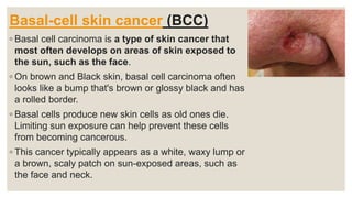 Basal-cell skin cancer (BCC)
◦ Basal cell carcinoma is a type of skin cancer that
most often develops on areas of skin exposed to
the sun, such as the face.
◦ On brown and Black skin, basal cell carcinoma often
looks like a bump that's brown or glossy black and has
a rolled border.
◦ Basal cells produce new skin cells as old ones die.
Limiting sun exposure can help prevent these cells
from becoming cancerous.
◦ This cancer typically appears as a white, waxy lump or
a brown, scaly patch on sun-exposed areas, such as
the face and neck.
 