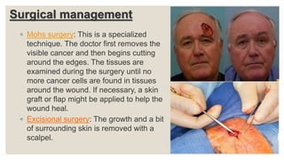 Surgical management
◦ Mohs surgery: This is a specialized
technique. The doctor first removes the
visible cancer and then begins cutting
around the edges. The tissues are
examined during the surgery until no
more cancer cells are found in tissues
around the wound. If necessary, a skin
graft or flap might be applied to help the
wound heal.
◦ Excisional surgery: The growth and a bit
of surrounding skin is removed with a
scalpel.
 