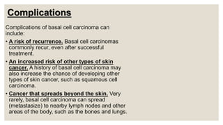 Complications
Complications of basal cell carcinoma can
include:
• A risk of recurrence. Basal cell carcinomas
commonly recur, even after successful
treatment.
• An increased risk of other types of skin
cancer. A history of basal cell carcinoma may
also increase the chance of developing other
types of skin cancer, such as squamous cell
carcinoma.
• Cancer that spreads beyond the skin. Very
rarely, basal cell carcinoma can spread
(metastasize) to nearby lymph nodes and other
areas of the body, such as the bones and lungs.
 