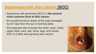 Squamous-cell skin cancer (SCC)
◦ Squamous cell carcinoma (SCC) is the second
most common form of skin cancer.
◦ It's usually found on areas of the body damaged
by UV rays from the sun or tanning beds.
◦ Sun-exposed skin includes the head, neck, chest,
upper back, ears, lips, arms, legs, and hands.
SCC is a fairly slow-growing skin cancer.
 