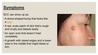 Symptoms
SCC can show up as:
• A dome-shaped bump that looks like
a wart
• A red, scaly patch of skin that’s rough
and crusty and bleeds easily
• An open sore that doesn’t heal
completely
• A growth with raised edges and a lower
area in the middle that might bleed or
itch.
 