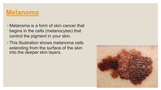 Melanoma
◦ Melanoma is a form of skin cancer that
begins in the cells (melanocytes) that
control the pigment in your skin.
◦ This illustration shows melanoma cells
extending from the surface of the skin
into the deeper skin layers.
 