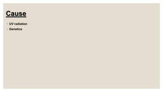 Cause
◦ UV radiation
◦ Genetics
 