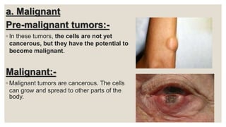 a. Malignant
Pre-malignant tumors:-
◦ In these tumors, the cells are not yet
cancerous, but they have the potential to
become malignant.
Malignant:-
◦ Malignant tumors are cancerous. The cells
can grow and spread to other parts of the
body.
 