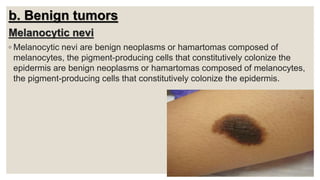 b. Benign tumors
Melanocytic nevi
◦ Melanocytic nevi are benign neoplasms or hamartomas composed of
melanocytes, the pigment-producing cells that constitutively colonize the
epidermis are benign neoplasms or hamartomas composed of melanocytes,
the pigment-producing cells that constitutively colonize the epidermis.
 