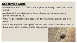 Seborrheic warts
◦ A non-cancerous skin condition that appears as a waxy brown, black or tan
growth.
◦ A seborrheic keratosis is one of the most common non-cancerous skin
growths in older adults.
◦ While it's possible for one to appear on its own, multiple growths are more
common.
◦ Seborrheic keratosis often appears on the face, chest, shoulders or back. It
has a waxy, scaly, slightly elevated appearance.
 