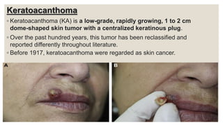 Keratoacanthoma
◦ Keratoacanthoma (KA) is a low-grade, rapidly growing, 1 to 2 cm
dome-shaped skin tumor with a centralized keratinous plug.
◦ Over the past hundred years, this tumor has been reclassified and
reported differently throughout literature.
◦ Before 1917, keratoacanthoma were regarded as skin cancer.
 