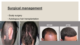 Surgical management
◦ Scalp surgery
◦ Autologous hair transplantation
 