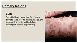 Primary lesions
Bulla
Fluid-filled lesion more than %" (2 cm) in
diameter (also called a blister) (e.g., severe
poison oak or ivy dermatitis, bullous
pemphigoid, second-degree burn)
24
 