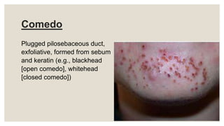 Comedo
Plugged pilosebaceous duct,
exfoliative, formed from sebum
and keratin (e.g., blackhead
[open comedo], whitehead
[closed comedo])
 