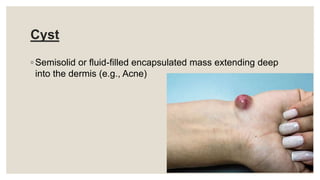 Cyst
◦ Semisolid or fluid-filled encapsulated mass extending deep
into the dermis (e.g., Acne)
 