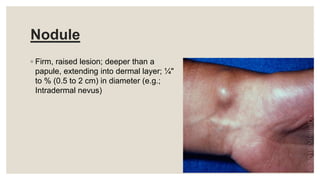 Nodule
◦ Firm, raised lesion; deeper than a
papule, extending into dermal layer; ¼"
to % (0.5 to 2 cm) in diameter (e.g.;
Intradermal nevus)
 