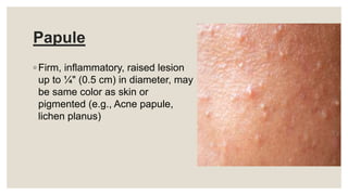 Papule
◦ Firm, inflammatory, raised lesion
up to ¼" (0.5 cm) in diameter, may
be same color as skin or
pigmented (e.g., Acne papule,
lichen planus)
 