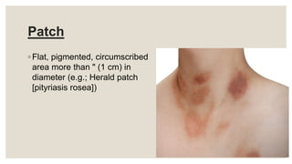 Patch
◦ Flat, pigmented, circumscribed
area more than " (1 cm) in
diameter (e.g.; Herald patch
[pityriasis rosea])
 