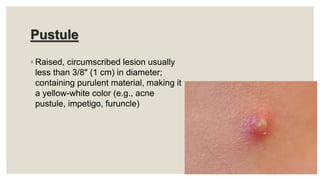 Pustule
◦ Raised, circumscribed lesion usually
less than 3/8" (1 cm) in diameter;
containing purulent material, making it
a yellow-white color (e.g., acne
pustule, impetigo, furuncle)
 
