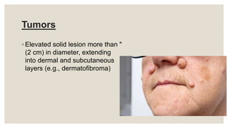 Tumors
◦ Elevated solid lesion more than "
(2 cm) in diameter, extending
into dermal and subcutaneous
layers (e.g., dermatofibroma)
 