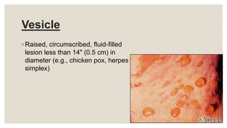 Vesicle
◦ Raised, circumscribed, fluid-filled
lesion less than 14" (0.5 cm) in
diameter (e.g., chicken pox, herpes
simplex)
 