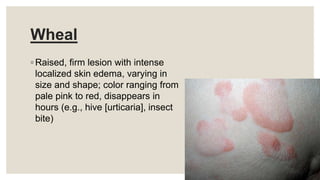 Wheal
◦ Raised, firm lesion with intense
localized skin edema, varying in
size and shape; color ranging from
pale pink to red, disappears in
hours (e.g., hive [urticaria], insect
bite)
 
