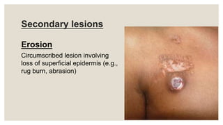 Secondary lesions
Erosion
Circumscribed lesion involving
loss of superficial epidermis (e.g.,
rug burn, abrasion)
 
