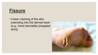 Fissure
◦ Linear cracking of the skin
extending into the dermal layer
(e.g.; hand dermatitis [chapped
skin]).
 
