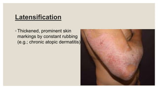 Latensification
◦ Thickened, prominent skin
markings by constant rubbing
(e.g.; chronic atopic dermatitis)
 
