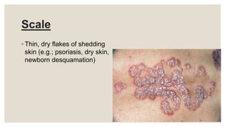 Scale
◦ Thin, dry flakes of shedding
skin (e.g.; psoriasis, dry skin,
newborn desquamation)
 