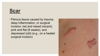 Scar
◦ Fibrous tissue caused by trauma,
deep inflammation, or surgical
incision; red and raised (recent),
pink and flat (6 weeks), and
depressed (old) (e.g., on a healed
surgical incision)
 
