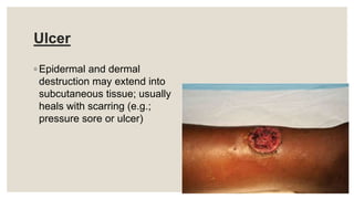 Ulcer
◦ Epidermal and dermal
destruction may extend into
subcutaneous tissue; usually
heals with scarring (e.g.;
pressure sore or ulcer)
 