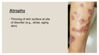 Atrophy
◦ Thinning of skin surface at site
of disorder (e.g., striae, aging
skin)
 