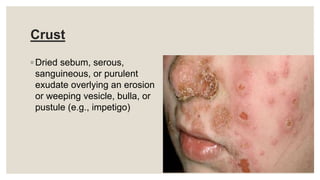 Crust
◦ Dried sebum, serous,
sanguineous, or purulent
exudate overlying an erosion
or weeping vesicle, bulla, or
pustule (e.g., impetigo)
 
