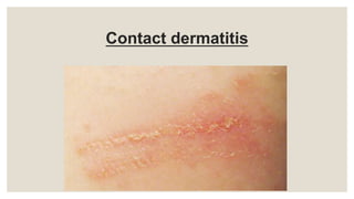 Contact dermatitis
 