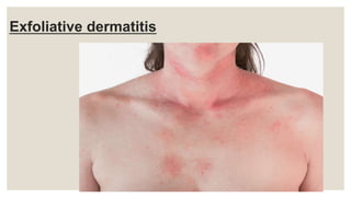 Exfoliative dermatitis
 