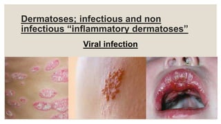 Dermatoses; infectious and non
infectious “inflammatory dermatoses”
Viral infection
 