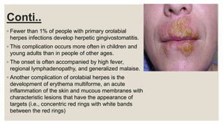 Conti..
◦ Fewer than 1% of people with primary orolabial
herpes infections develop herpetic gingivostomatitis.
◦ This complication occurs more often in children and
young adults than in people of other ages.
◦ The onset is often accompanied by high fever,
regional lymphadenopathy, and generalized malaise.
◦ Another complication of orolabial herpes is the
development of erythema multiforme, an acute
inflammation of the skin and mucous membranes with
characteristic lesions that have the appearance of
targets (i.e., concentric red rings with white bands
between the red rings)
 