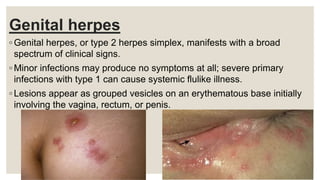 Genital herpes
◦ Genital herpes, or type 2 herpes simplex, manifests with a broad
spectrum of clinical signs.
◦ Minor infections may produce no symptoms at all; severe primary
infections with type 1 can cause systemic flulike illness.
◦ Lesions appear as grouped vesicles on an erythematous base initially
involving the vagina, rectum, or penis.
 